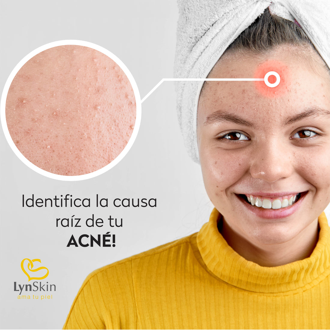 ¿Por qué tengo Acné?