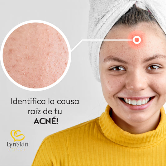 ¿Por qué tengo Acné?