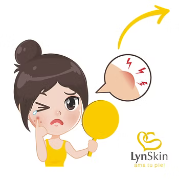 ¿Qué hormona hace que te salga acné?