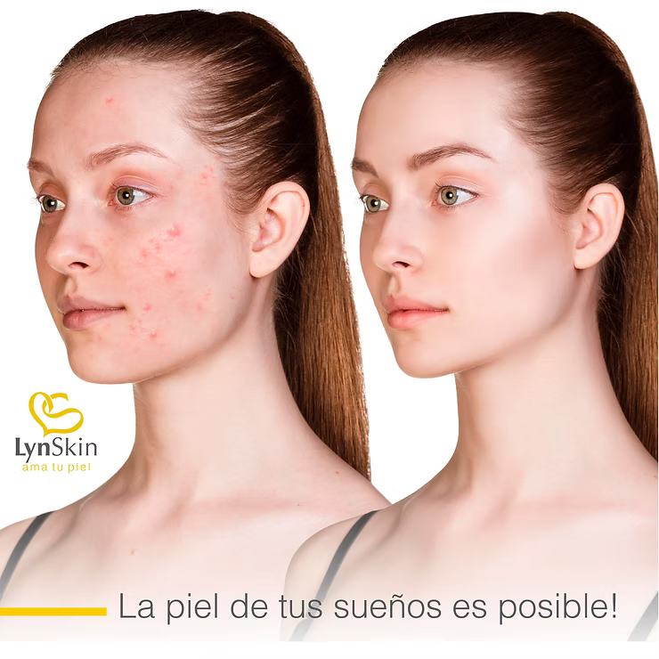 ¿Qué es la hiperpigmentación post-inflamatoria y qué la causa?