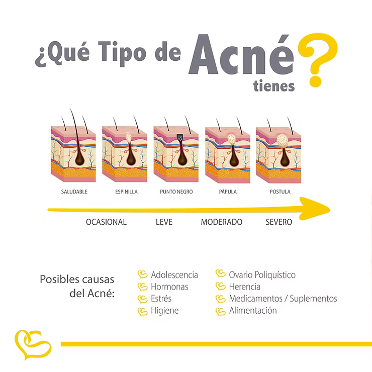 niveles y tipo de acne