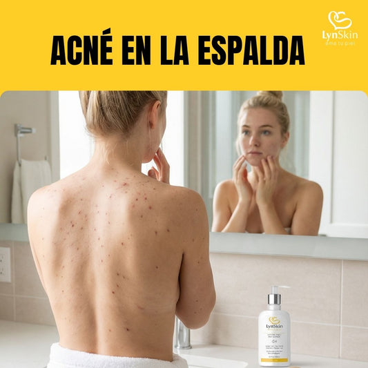 Acné en la espalda: por qué aparece y cómo puedes mejorarlo