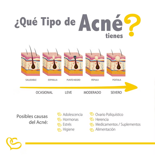 niveles y tipo de acne 